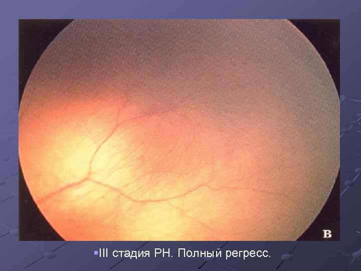 §III стадия РН. Полный регресс. 