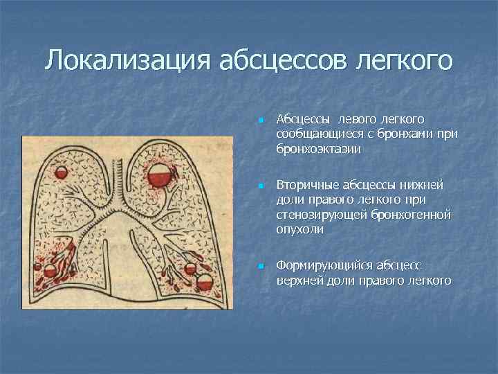 Локализация абсцессов легкого n n n Абсцессы левого легкого сообщающиеся с бронхами при бронхоэктазии