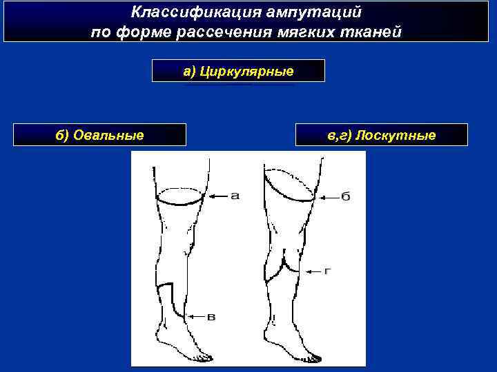 Ампутация бедра классификация. Ампутация нижней конечности средняя треть бедра. Ампутация стопы классификация. Этапы ампутации нижней конечности.