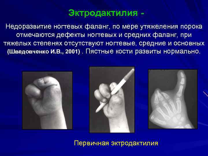 Эктродактилия Недоразвитие ногтевых фаланг, по мере утяжеления порока отмечаются дефекты ногтевых и средних фаланг,