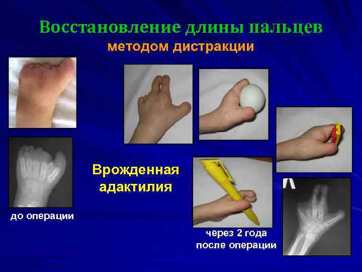 Восстановление длины пальцев методом дистракции Врожденная адактилия до операции через 2 года после операции