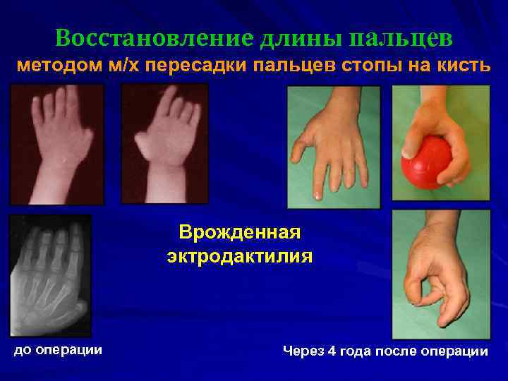 Восстановление длины пальцев методом м/х пересадки пальцев стопы на кисть Врожденная эктродактилия до операции