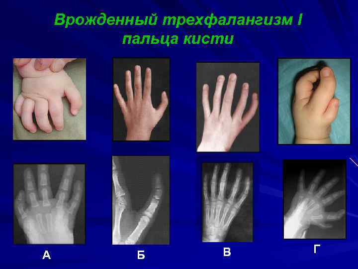 Развилось запястье. Врожденная аномалия развития кистей. Аномалии развития пальцев.