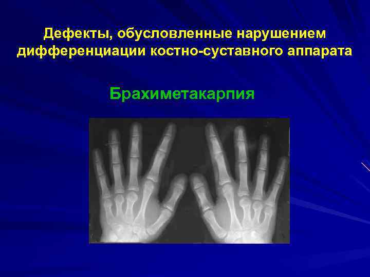Дефекты, обусловленные нарушением дифференциации костно-суставного аппарата Брахиметакарпия 