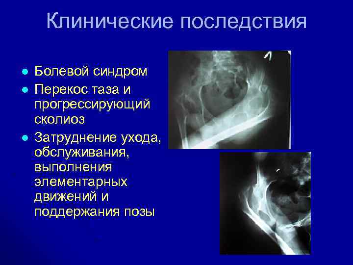 Клинические последствия l l l Болевой синдром Перекос таза и прогрессирующий сколиоз Затруднение ухода,