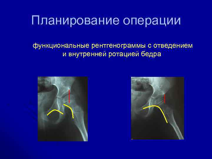 Планирование операции функциональные рентгенограммы с отведением и внутренней ротацией бедра 