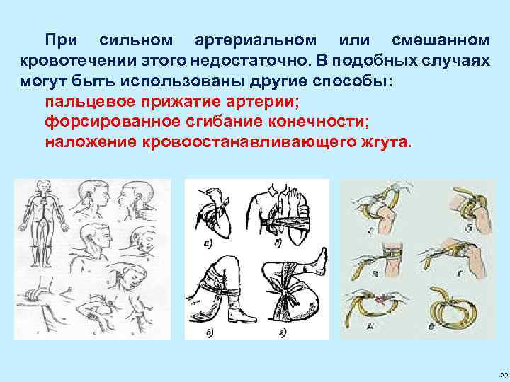 При сильном артериальном или смешанном кровотечении этого недостаточно. В подобных случаях могут быть использованы