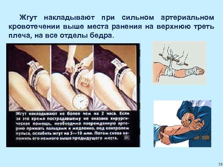 Жгут накладывают при сильном артериальном кровотечении выше места ранения на верхнюю треть плеча, на