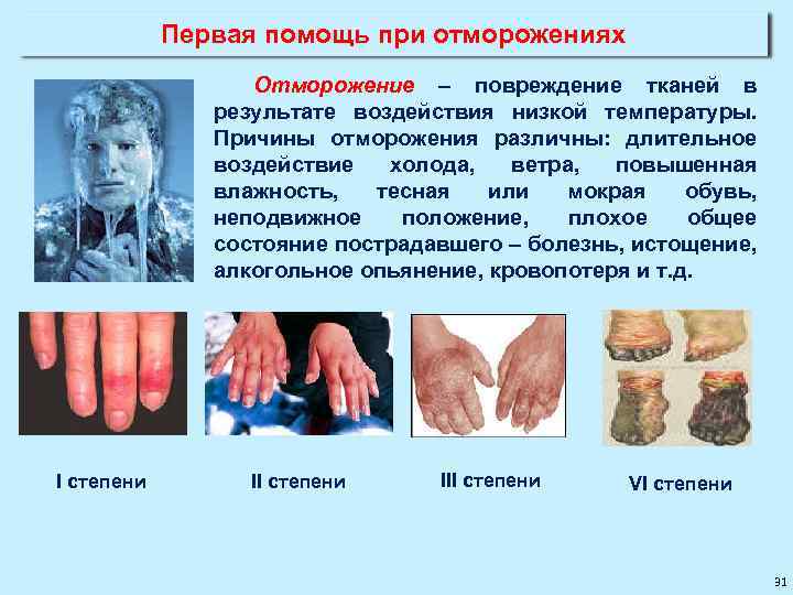 Первая помощь при отморожениях Отморожение – повреждение тканей в результате воздействия низкой температуры. Причины