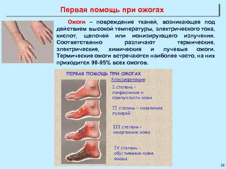 Первая помощь при ожогах Ожоги – повреждение тканей, возникающее под действием высокой температуры, электрического