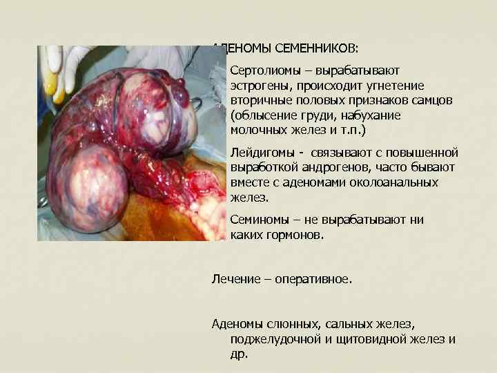 АДЕНОМЫ СЕМЕННИКОВ: 1. Сертолиомы – вырабатывают эстрогены, происходит угнетение вторичные половых признаков самцов (облысение