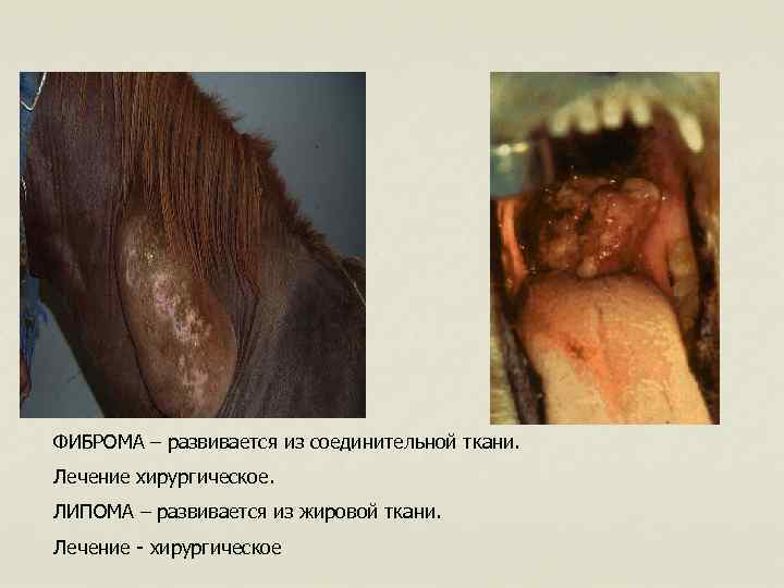 ФИБРОМА – развивается из соединительной ткани. Лечение хирургическое. ЛИПОМА – развивается из жировой ткани.