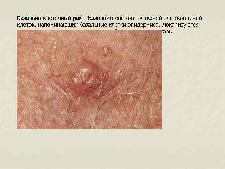 Базально-клеточный рак – базиломы состоят из тканей или скоплений клеток, напоминающих базальные клетки эпидермиса.