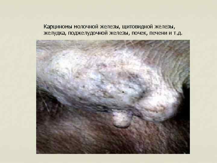 Карциномы молочной железы, щитовидной железы, желудка, поджелудочной железы, почек, печени и т. д. 