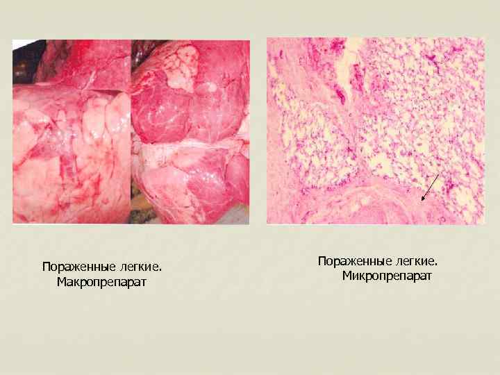  Пораженные легкие. Макропрепарат Пораженные легкие. Микропрепарат 