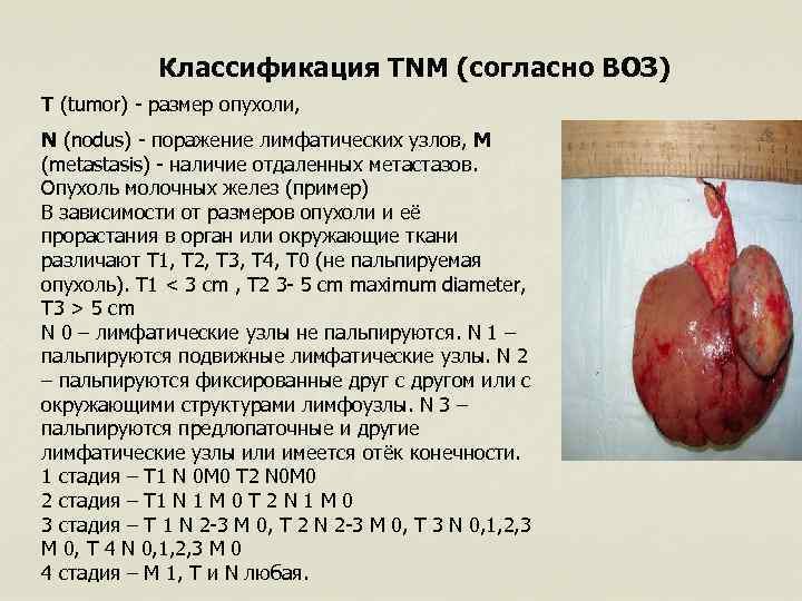 Классификация TNM (согласно ВОЗ) T (tumor) - размер опухоли, N (nodus) - поражение лимфатических