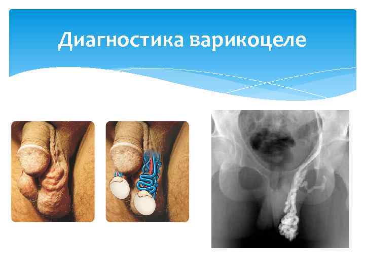 Диагностика варикоцеле 