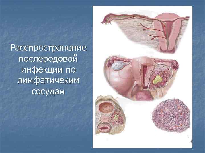 Расспространение послеродовой инфекции по лимфатичеким сосудам 