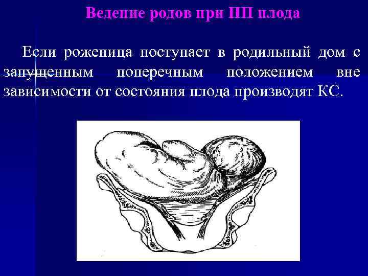Ведение родов при НП плода Если роженица поступает в родильный дом с запущенным поперечным