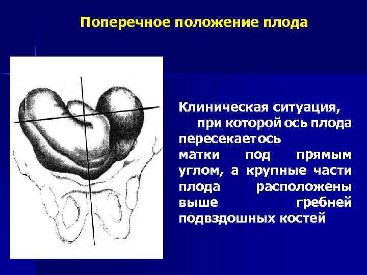 Поперечное положение плода Клиническая ситуация, при которой ось плода пересекает ось матки под прямым