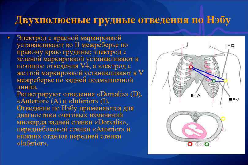 Двухполюсные грудные отведения по Нэбу • Электрод с красной маркировкой устанавливают во II межреберье
