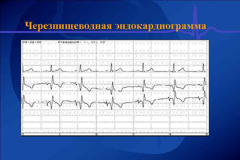 Черезпищеводная эндокардиограмма 