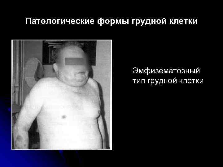 Патологические формы грудной клетки Эмфизематозный тип грудной клетки 