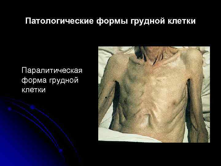 Патологические формы грудной клетки Паралитическая форма грудной клетки 