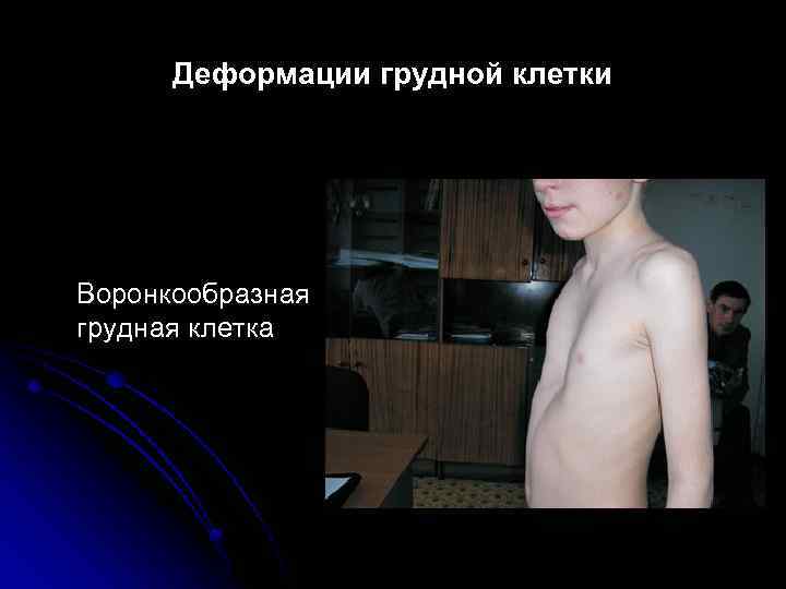 Деформации грудной клетки Воронкообразная грудная клетка 