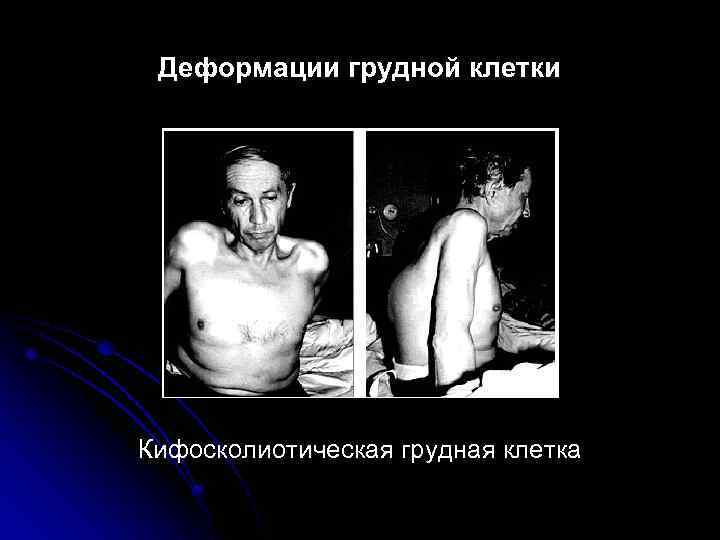 Деформации грудной клетки Кифосколиотическая грудная клетка 