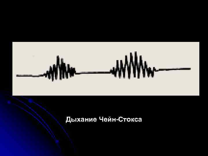 Дыхание Чейн-Стокса 