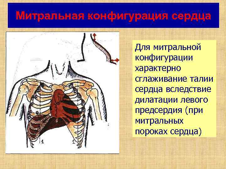 Митральная конфигурация сердца Для митральной конфигурации характерно сглаживание талии сердца вследствие дилатации левого предсердия