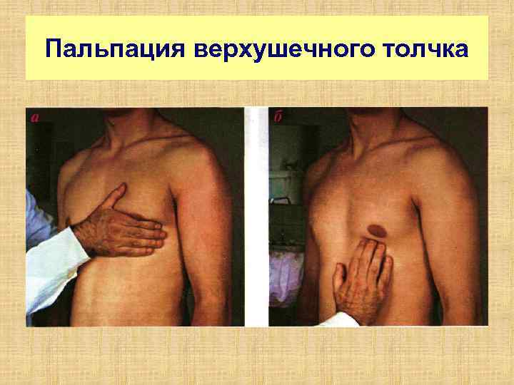 Пальпация верхушечного толчка 