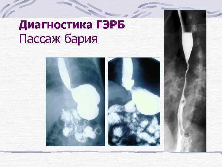 Диагностика ГЭРБ Пассаж бария 