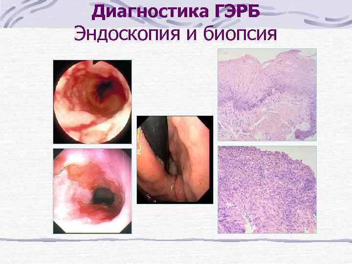 Диагностика ГЭРБ Эндоскопия и биопсия 