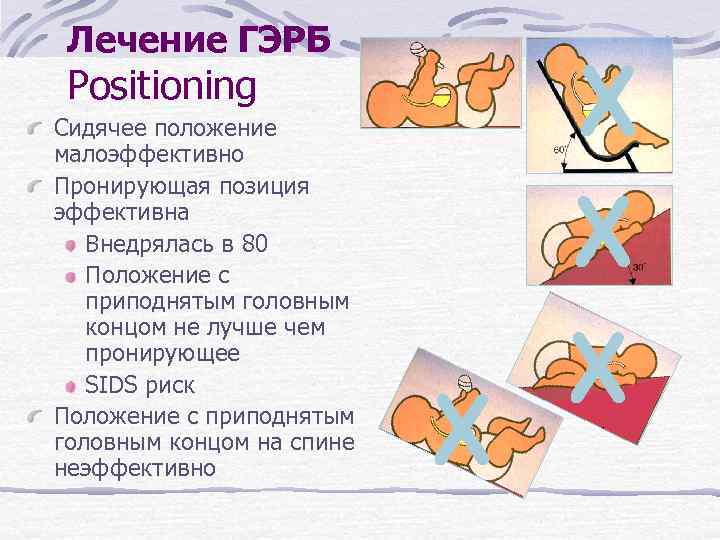 Лечение ГЭРБ Positioning Сидячее положение малоэффективно Пронирующая позиция эффективна Внедрялась в 80 Положение с