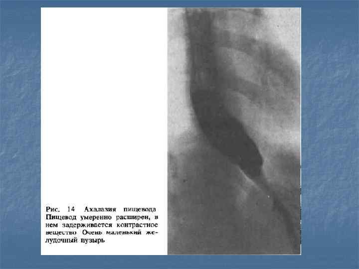 Рентгенологическая картина ахалазии пищевода
