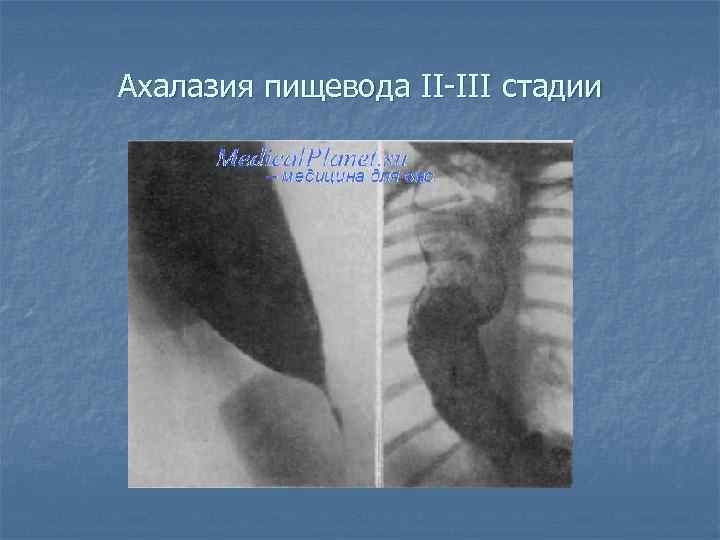 Ахалазия пищевода II-III стадии 