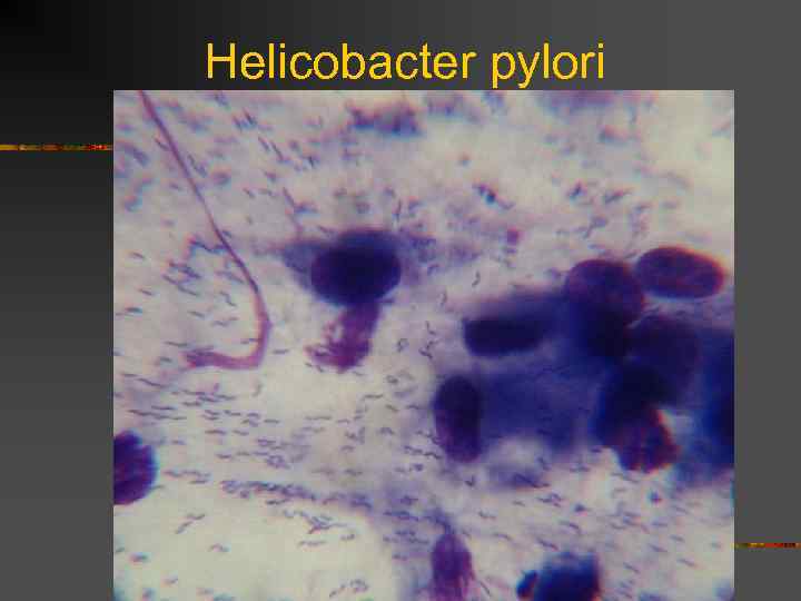 Helicobacter pylori 