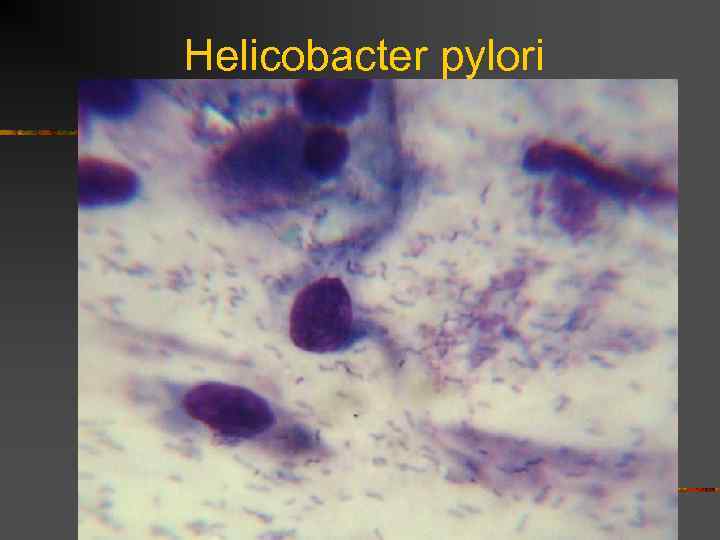 Helicobacter pylori 