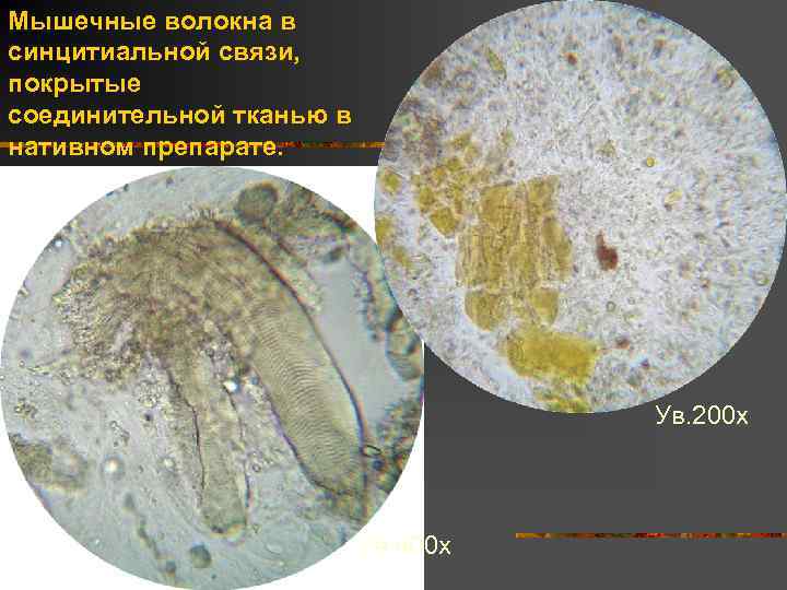 Растительная клетчатка непереваримая. Микроскопия кала мышечные волокна. Копрология микроскопия.