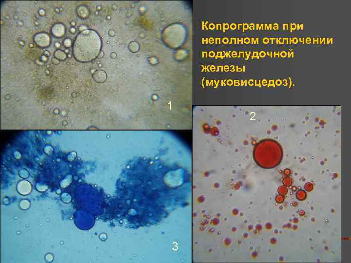 Копрограмма 3. Копрограмма. Копрограмма микроскопия. Копрограмма исследование микроскопическое исследование. Копрограмма поджелудочной железы.