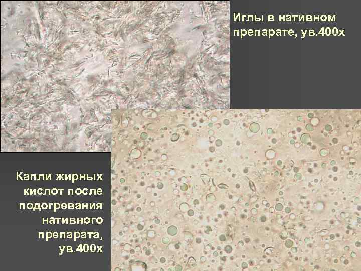 Иглы в нативном препарате, ув. 400 х Капли жирных кислот после подогревания нативного препарата,