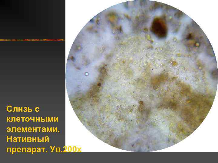 Слизь с клеточными элементами. Нативный препарат. Ув. 200 х 