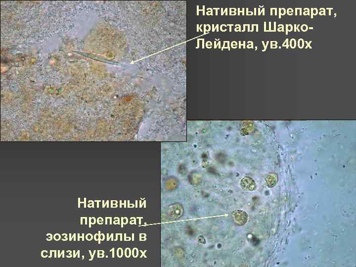 Нативный препарат, кристалл Шарко. Лейдена, ув. 400 х Нативный препарат, эозинофилы в слизи, ув.