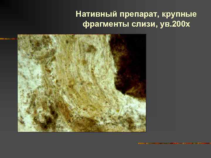Нативный препарат, крупные фрагменты слизи, ув. 200 х 