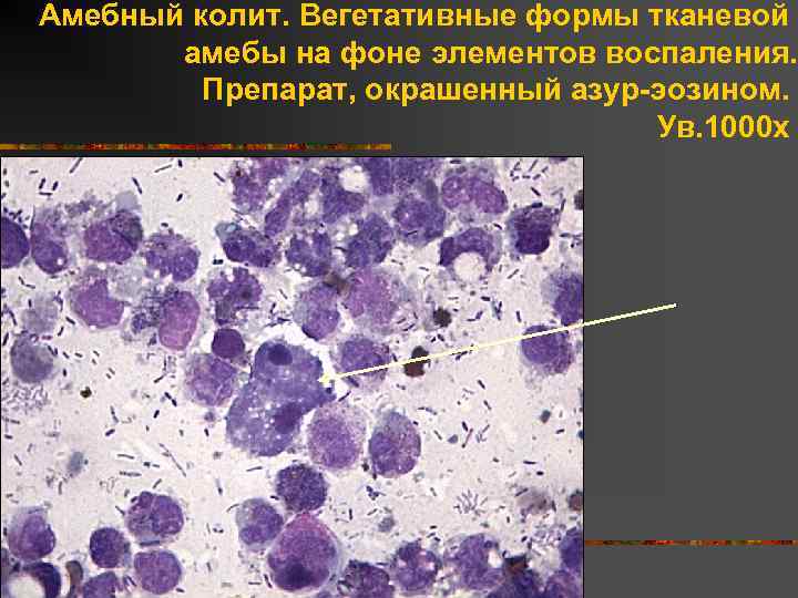 Амебный колит. Вегетативные формы тканевой амебы на фоне элементов воспаления. Препарат, окрашенный азур-эозином. Ув.