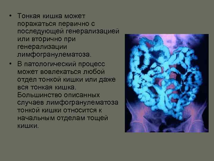  • Тонкая кишка может поражаться первично с последующей генерализацией или вторично при генерализации