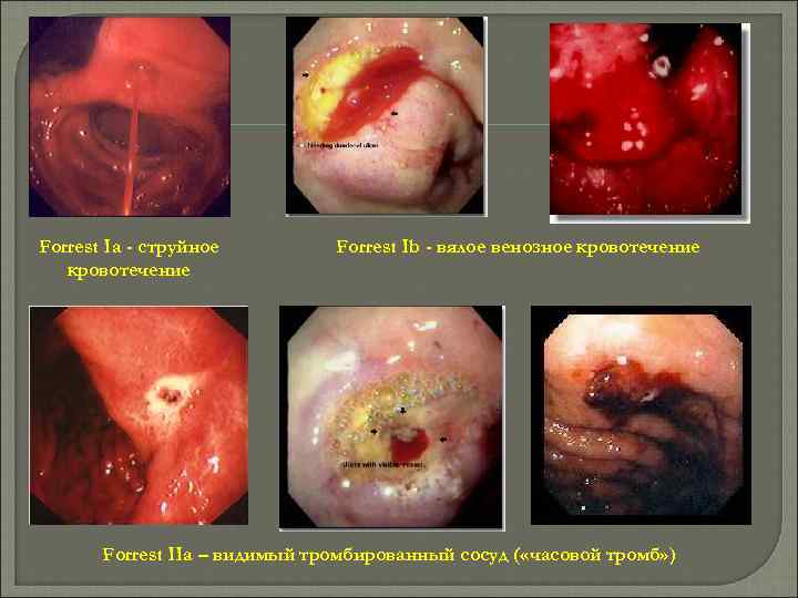 Forrest Ia - струйное кровотечение Forrest Ib - вялое венозное кровотечение Forrest IIa –