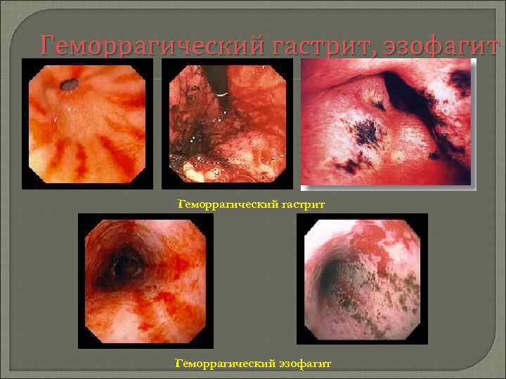 Геморрагический гастрит, эзофагит Геморрагический гастрит Геморрагический эзофагит 